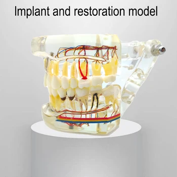 Modele Dentare De Dentist Implant Dentar Model Dinți Neuronale Reparații Implant Dentar Patologice Elev Model Instrumente De Laborator